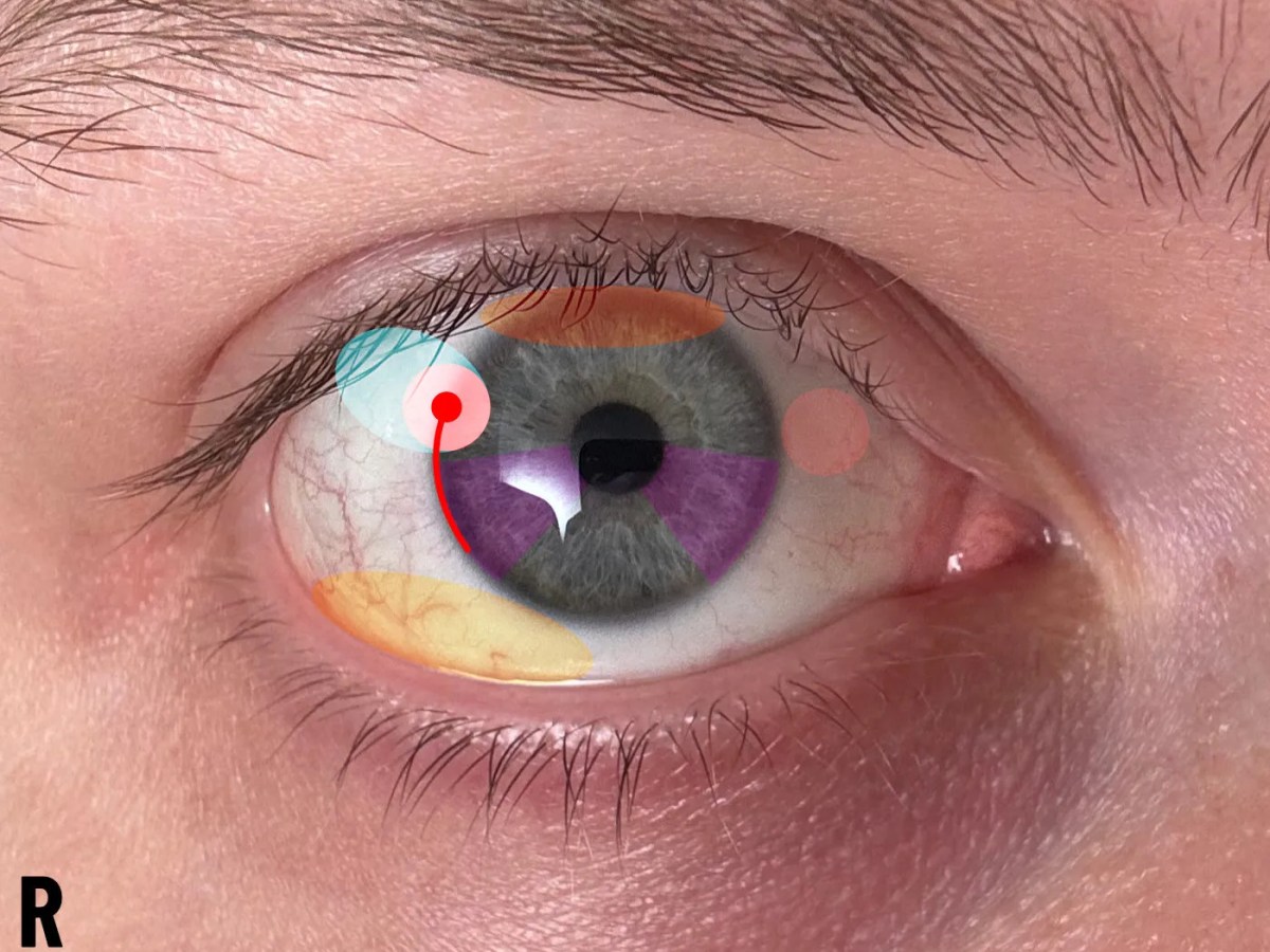 Steroids as a Topical Therapy for Corneal Neuralgia, along with Potential Gastric&nbsp;Risk