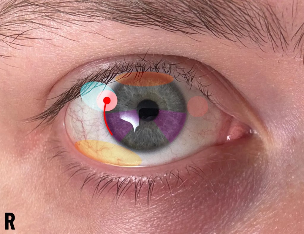 Steroids as a Topical Therapy for Corneal Neuralgia, along with Potential Gastric&nbsp;Risk